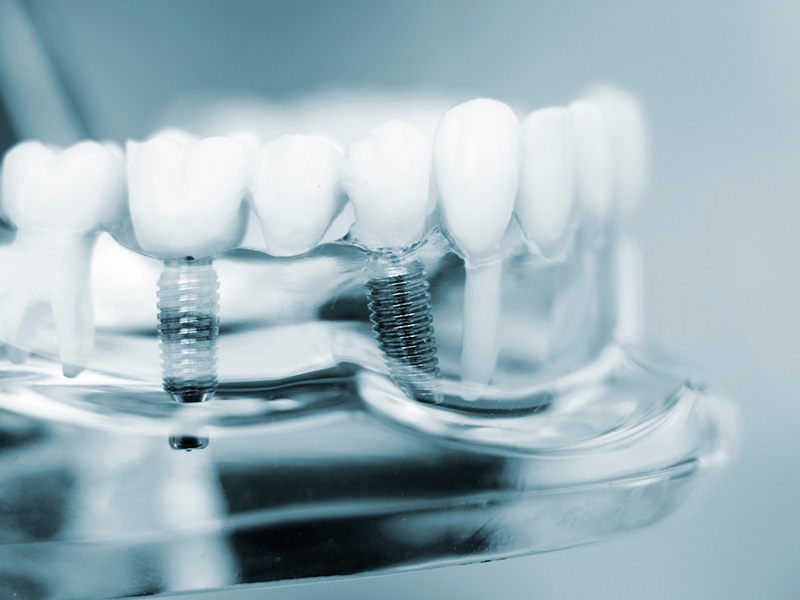 The image shows a close-up of a transparent dental implant fixture with a toothbrush in the background, highlighting the cleanliness and hygiene aspects of oral care.