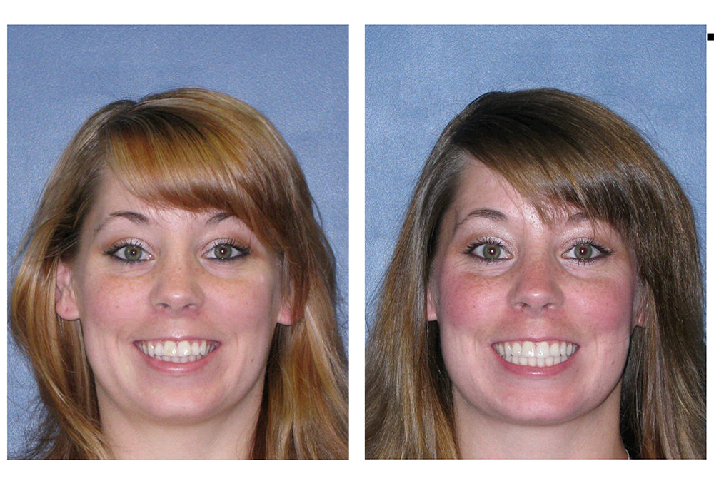 Before & After: Transform Your Smile With Invisalign - Brightway Dental, Pc