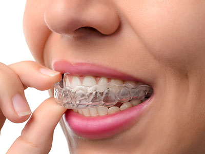 Image of a person holding a clear aligner with teeth in it, close to their mouth.