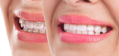 A woman s smiling face with a focus on her teeth and lips, captured in a close-up photograph.