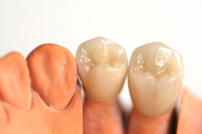 An image displaying two artificial teeth with a realistic texture and color, placed side by side against a white background.