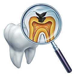 The image is a digital illustration that shows a magnified view of the interior of a human tooth, with a focus on the pulp chamber and root canal. A dental probe with an inset X-ray image of the same tooth is superimposed over the actual tooth, highlighting its internal structure for educational or diagnostic purposes.