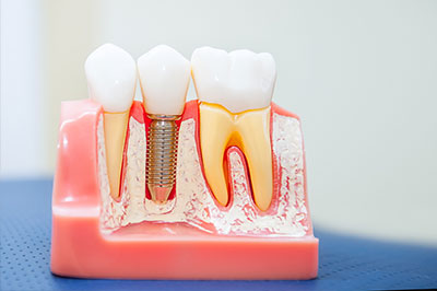 The image shows a close-up of a dental model with several artificial teeth and gums, featuring a metal screw that appears to be used for securing the teeth in place.