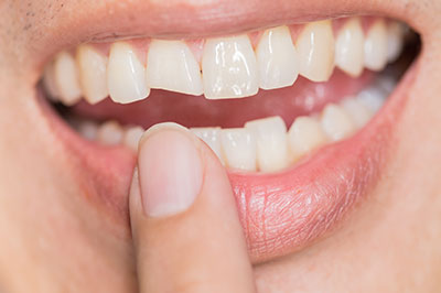 An individual holding a finger close to their mouth, showcasing teeth with a partial denture.