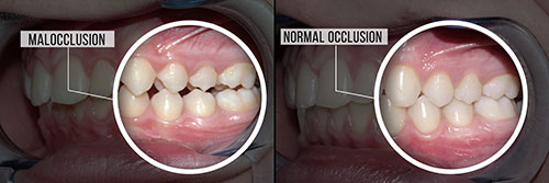 Before and after dental implant surgery, showcasing a normal occlusion in the lower teeth.