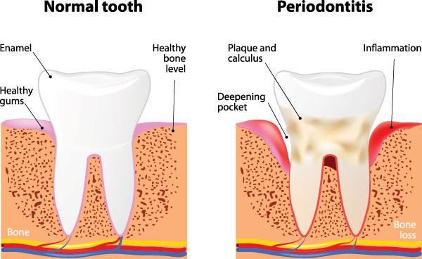 The image is a medical illustration showing the progression of gum disease from normal to severe stages, with labels indicating tooth decay and bone loss.