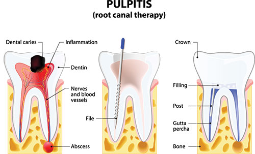 The image is a medical illustration showing the process of pulpitis, where dental caries have progressed to the point of inflammation and infection within the tooth s pulp chamber. It highlights the stages from initial decay to the presence of bacteria and inflammatory response, as well as the crown and filling that may be part of a previous dental treatment.