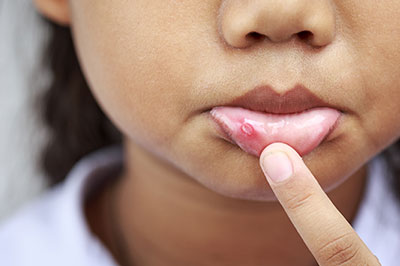 The image shows a close-up of a young person s face with an acne treatment patch applied to their cheek.