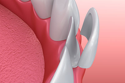 The image shows a close-up of a dental implant with an abutment, which is the metal piece that connects the implant to the crown.