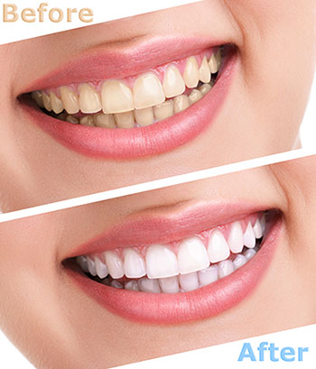 The image shows a before-and-after comparison of teeth whitening, with the left side showing yellowed teeth and the right side showing bright white teeth after treatment.