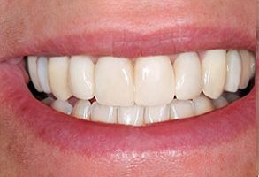 The image shows a close-up of a person s teeth and mouth, with the individual smiling.