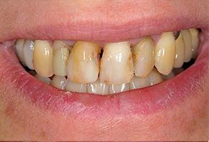 The image displays a close-up of a person s teeth, showing yellow discoloration and signs of dental decay.