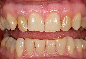 An image of a person s teeth with a focus on the bottom row, showcasing a dental treatment or orthodontic work.