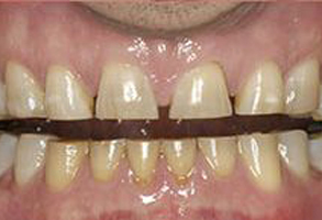 The image displays a person s mouth with a set of yellowed, stained teeth that appear to be in need of dental care.